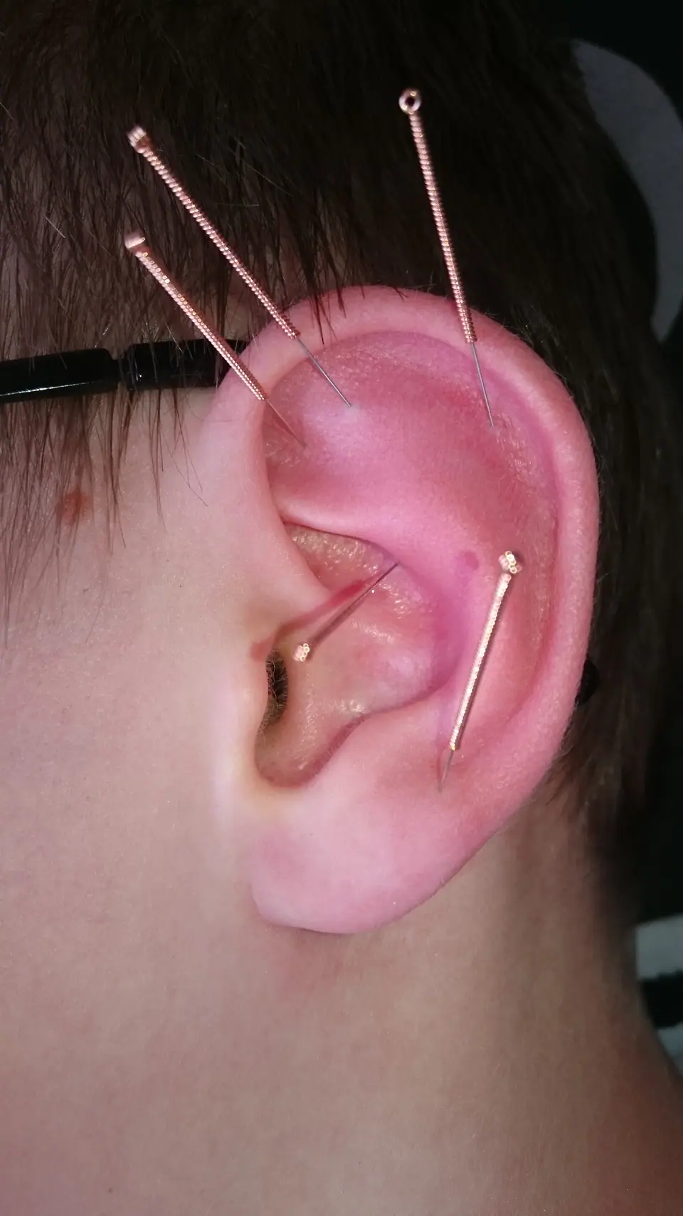 Agujas de auriculoterapia colocadas en distintos puntos de la oreja