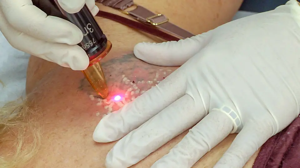 Sesión de láser para eliminar un tatuaje en el brazo
