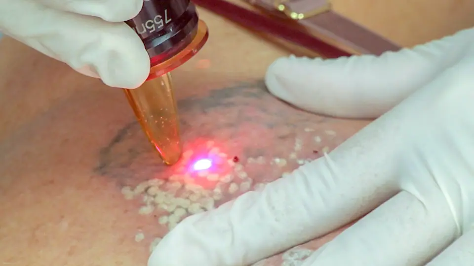 Aplicación de láser para eliminar un tatuaje, primer plano
